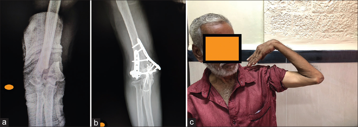 (a) Case 1 preoperative X-ray. (b) Case 1 postoperative X-ray (after fracture healing). (c) Case 1 functional outcome