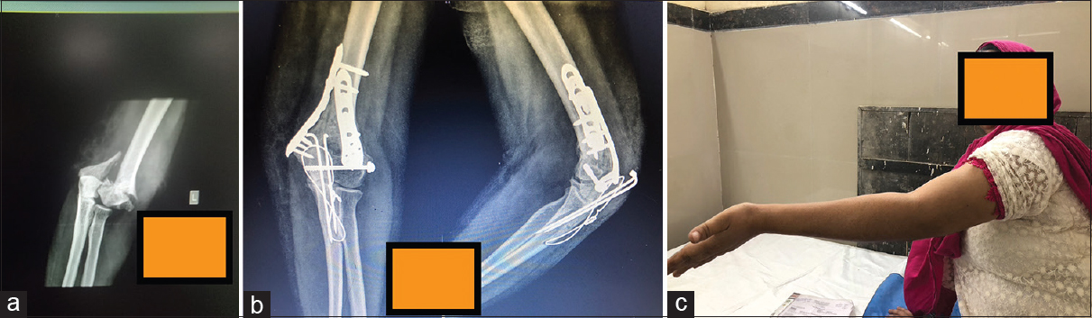 (a) Case 2 preoperative X-ray. (b) Case 2 postoperative X-ray (after fracture healing). (c) Case 2 functional outcome