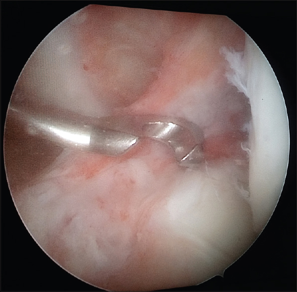 Anterior cruciate ligament guide in place alongside torn anterior cruciate ligament stump