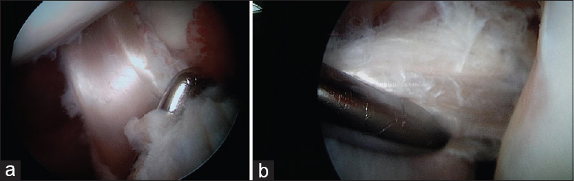 (a and b) Newly reconstructed anterior cruciate ligament graft along with old anterior cruciate ligament stump