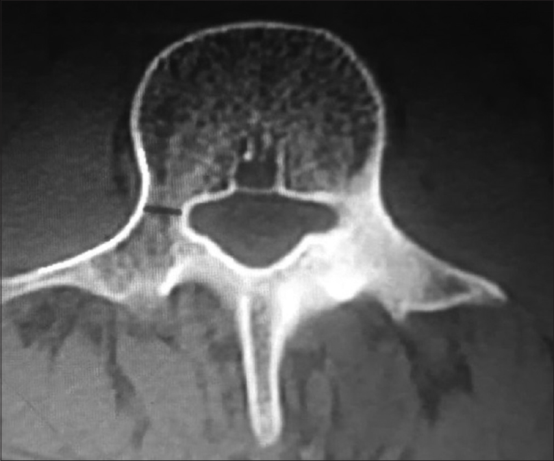 Calculation of transverse pedicle isthmus width