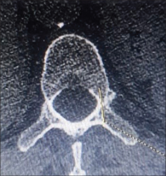 Calculation of pedicle length