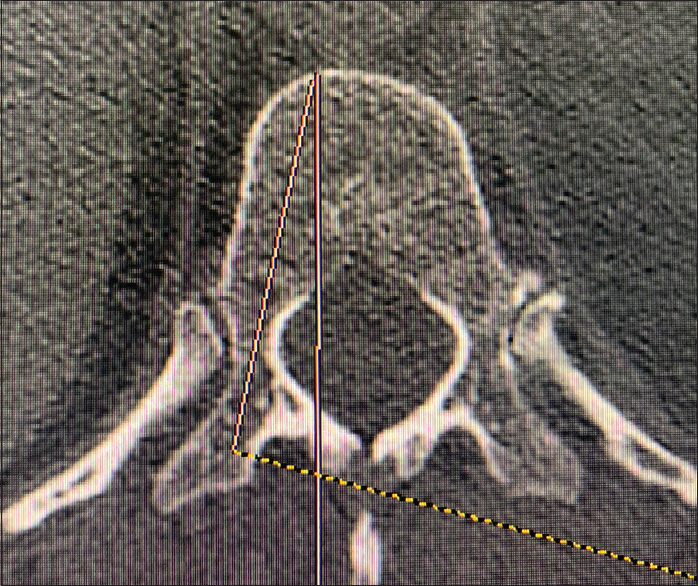 Calculation of transverse pedicle angle