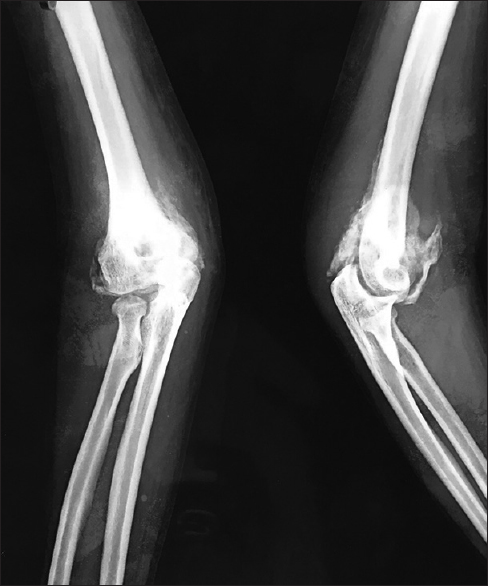 Preoperative radiograph showing heterotopic ossification around the elbow