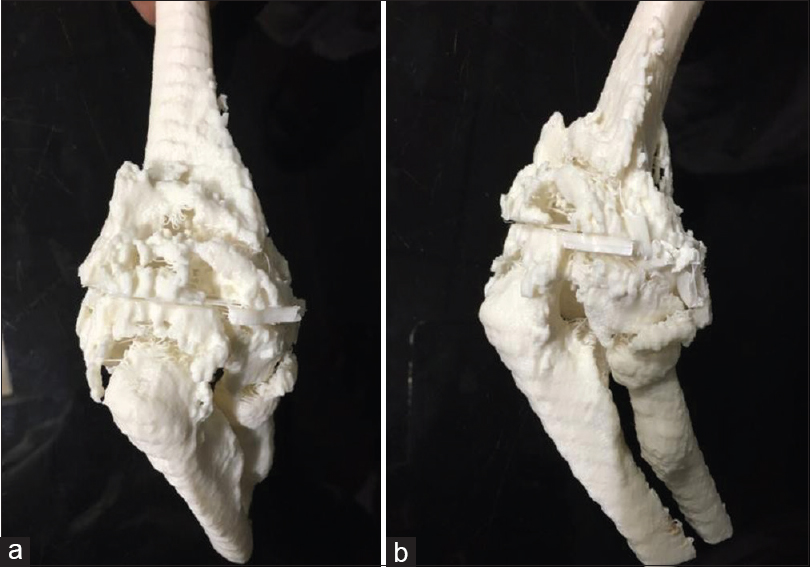 (a) Computed tomography -scan based three-dimensional-printed model of elbow with heterotopic ossification mass (viewed from front). (b) Computed tomography-scan-based three-dimensional-printed model of elbow with heterotopic ossification mass (viewed from the side)