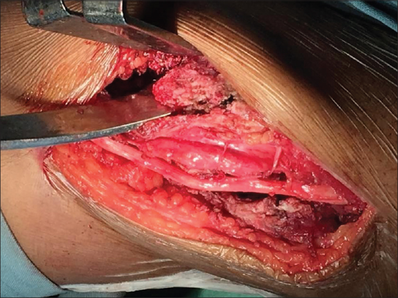 Intraoperative photograph showing resection of mass with the ulnar nerve protected