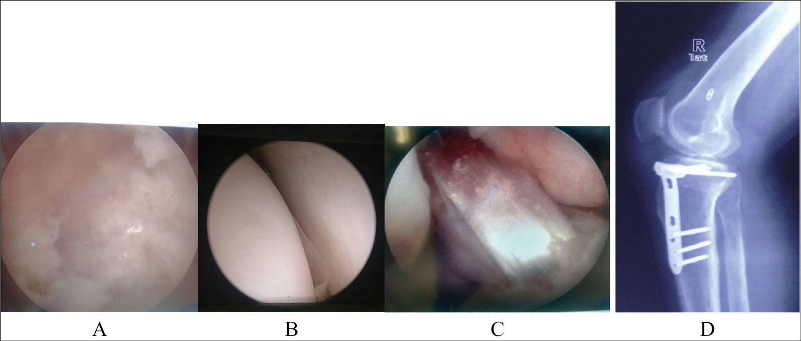 (A) Diagnostic arthroscopy suggestive of medial compartment OA of the knee, (B) arthroscopic normal lateral compartment (C) ACL reconstruction intraoperative status, (D) radiograph suggestive of ACL reconstruction and united proximal tibial osteotomy with the implant in situ