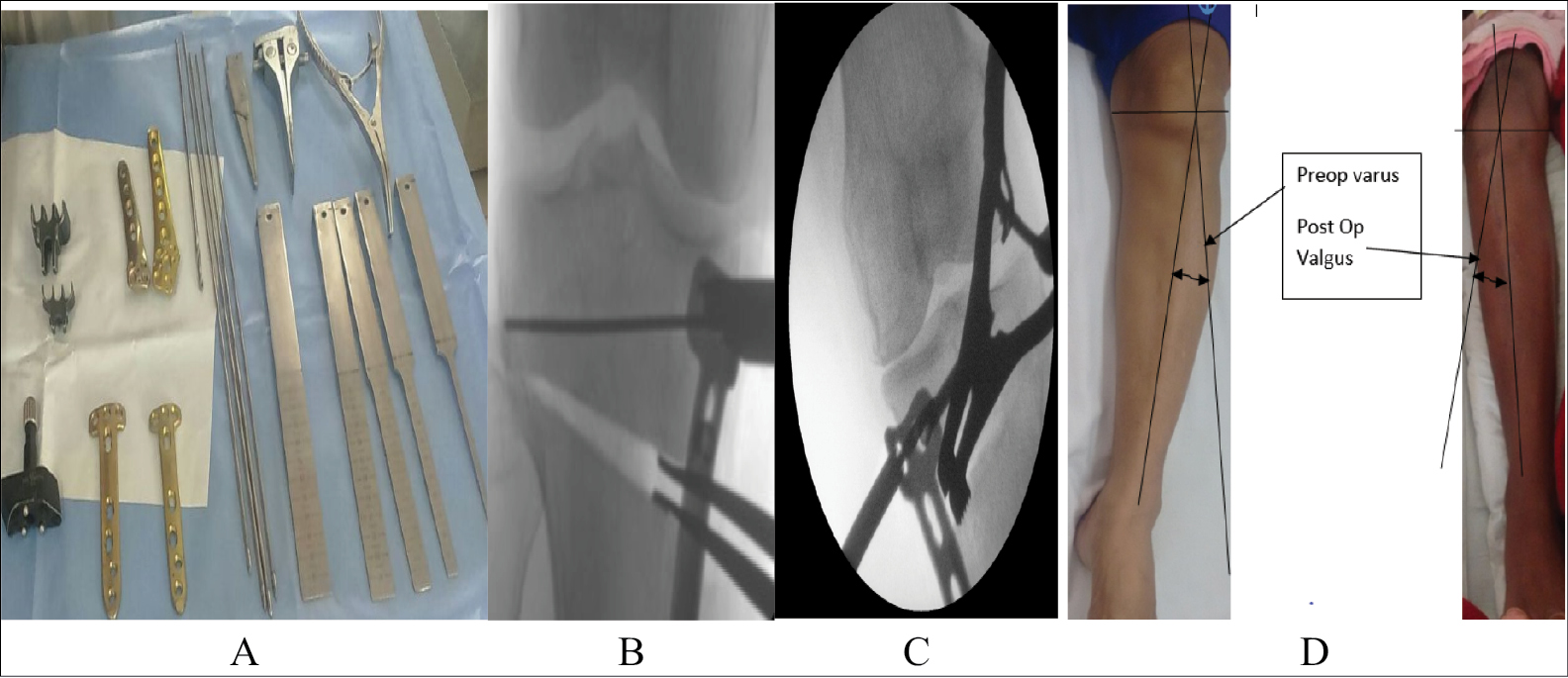 (A) Tomofix plate, osteotomy chisels, bone spreader, soft lock, osteotomy gap measuring device, guidewire and drill, chisels of different sizes (B) intraoperative fluoroscopic image, (C) maintained osteotomy site and fixing with Tomofix plate, (D) clinical picture of preoperative varus and postoperative valgus