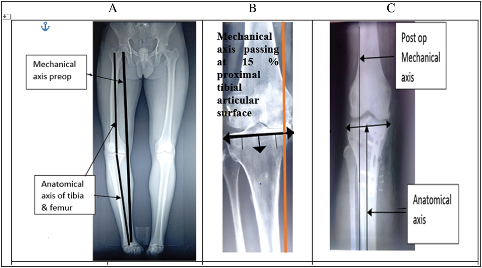 (A) Mechanical axis of leg and anatomical axis of femur and tibia (B) mechanical axis passing at 15% proximal tibial articular surface (C) post-operative mechanical axis