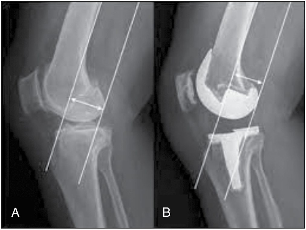 Posterior condylar offset: Preoperative (A) and postoperative (B)