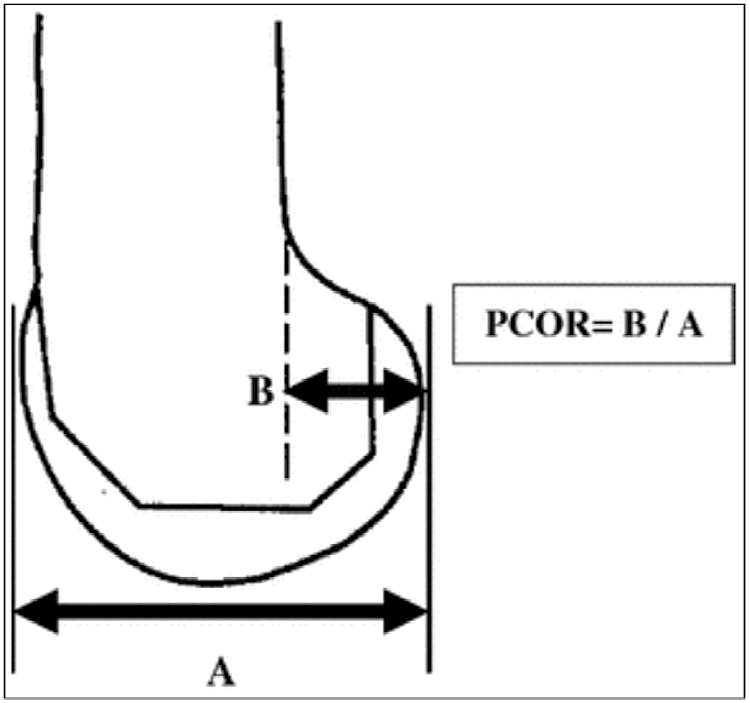 Posterior condylar offset ratio