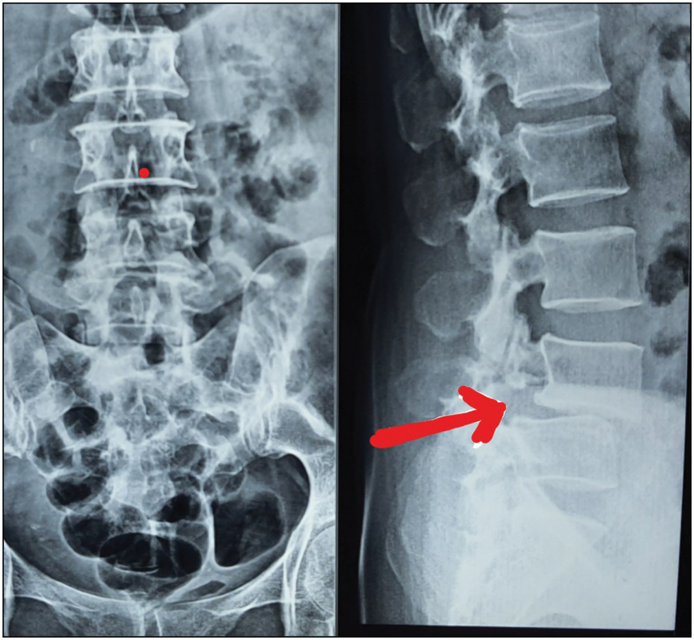 X-ray LS spine showing Grade II spondylolisthesis at L4-L5