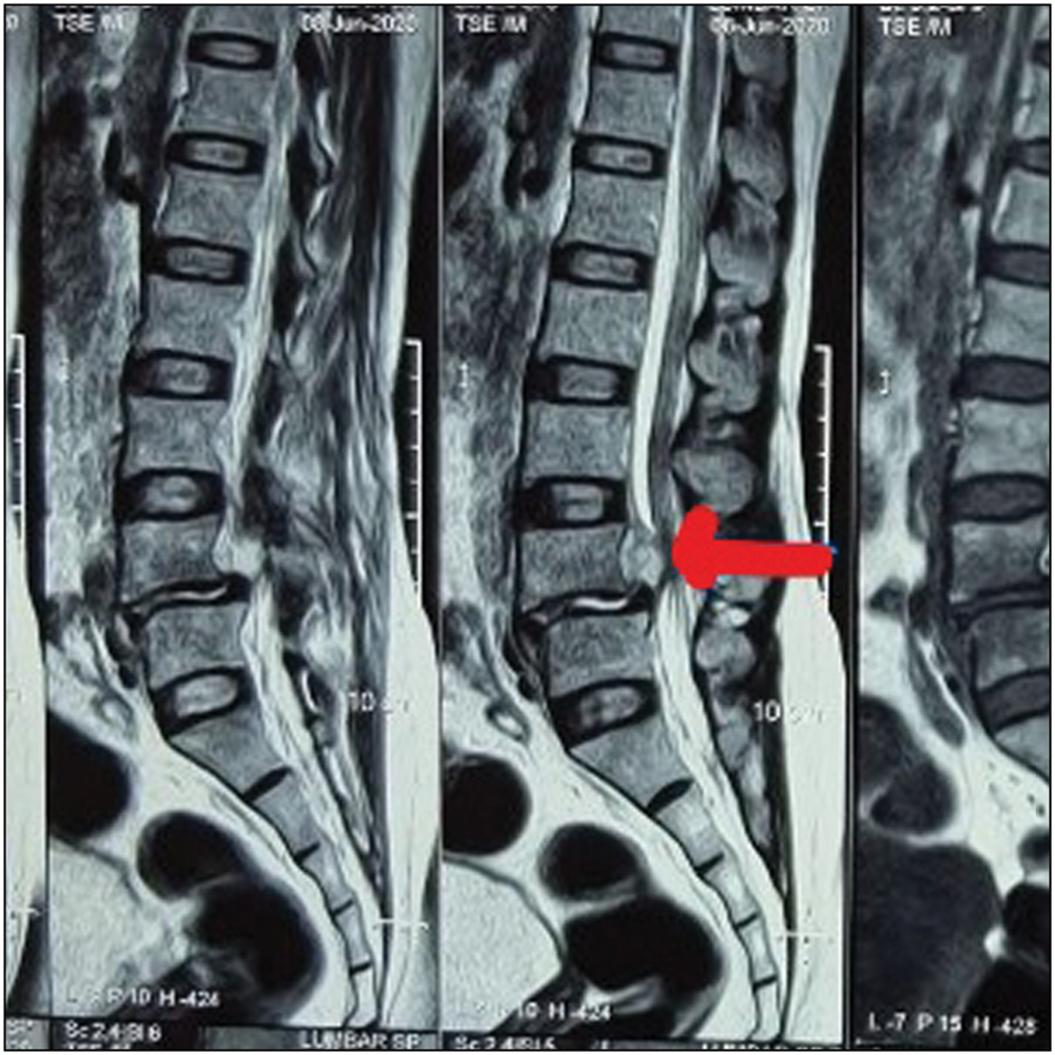 MRI (longitudinal section) showing spondylolysis with spondylolisthesis with an epidural abscess at L4-L5 with a defect in Pars interarticularis at L4-level with epidural abscess and reduced disc space at the same level, no paraspinal soft tissue involvement or gibbus formation