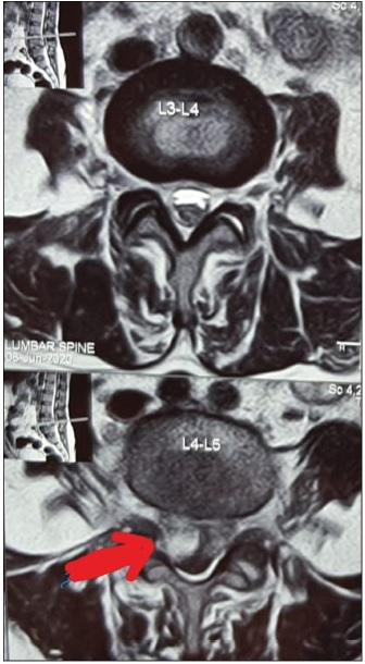 MRI (transverse section) showing spondylolysis with spondylolisthesis with an epidural abscess at L4-L5 with a defect in Pars interarticularis at L4-level with epidural abscess and reduced disc space at the same level, no paraspinal soft tissue involvement or gibbus formation