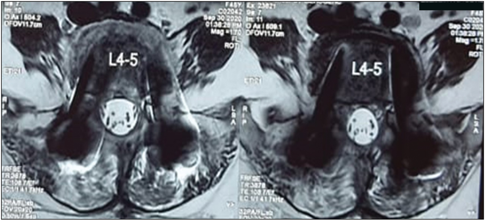 MRI (transverse section) showing complete resolution of epidural abscess, no abnormal signal changes within vertebral bodies/ L4, L5 discs