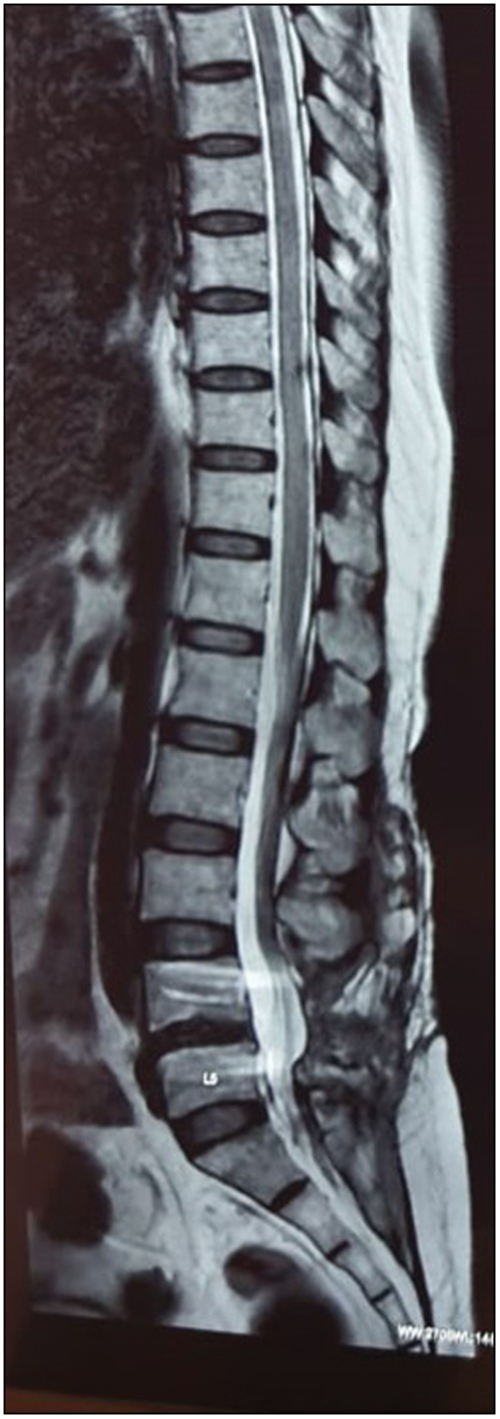 MRI (longitudinal section) showing complete resolution of epidural abscess, no abnormal signal changes within vertebral bodies/ L4, L5 discs