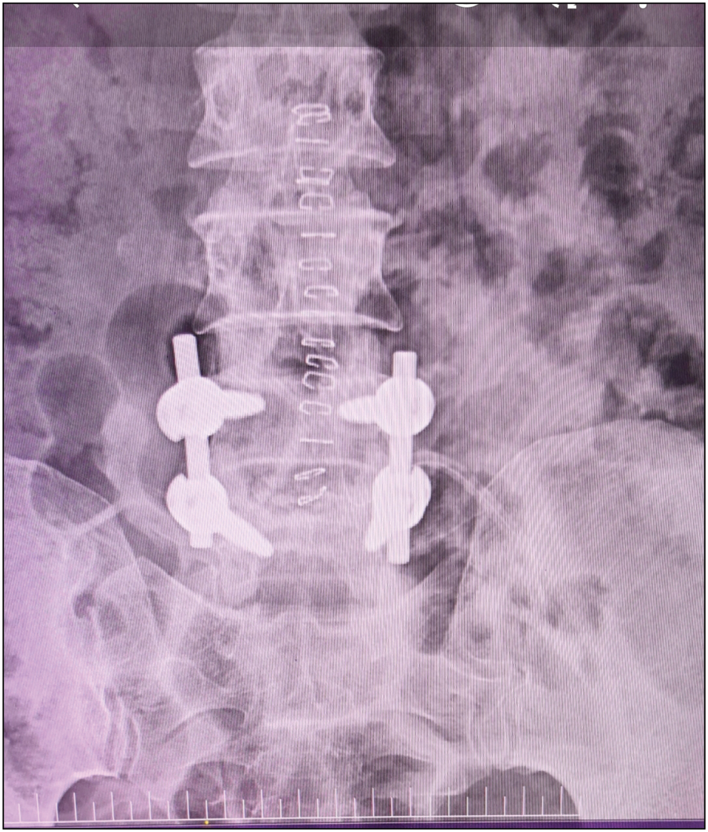 Follow-up X-ray showing discs with pedicular screws in situ