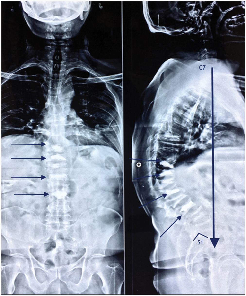 Showing multiple OVCF, positive sagittal balance, and five vertebrae augmented with bone cement