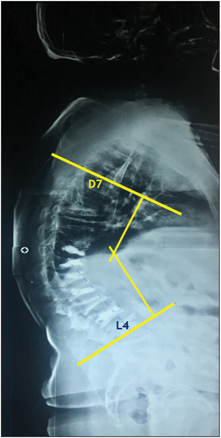 Global kyphosis with K angle of 650