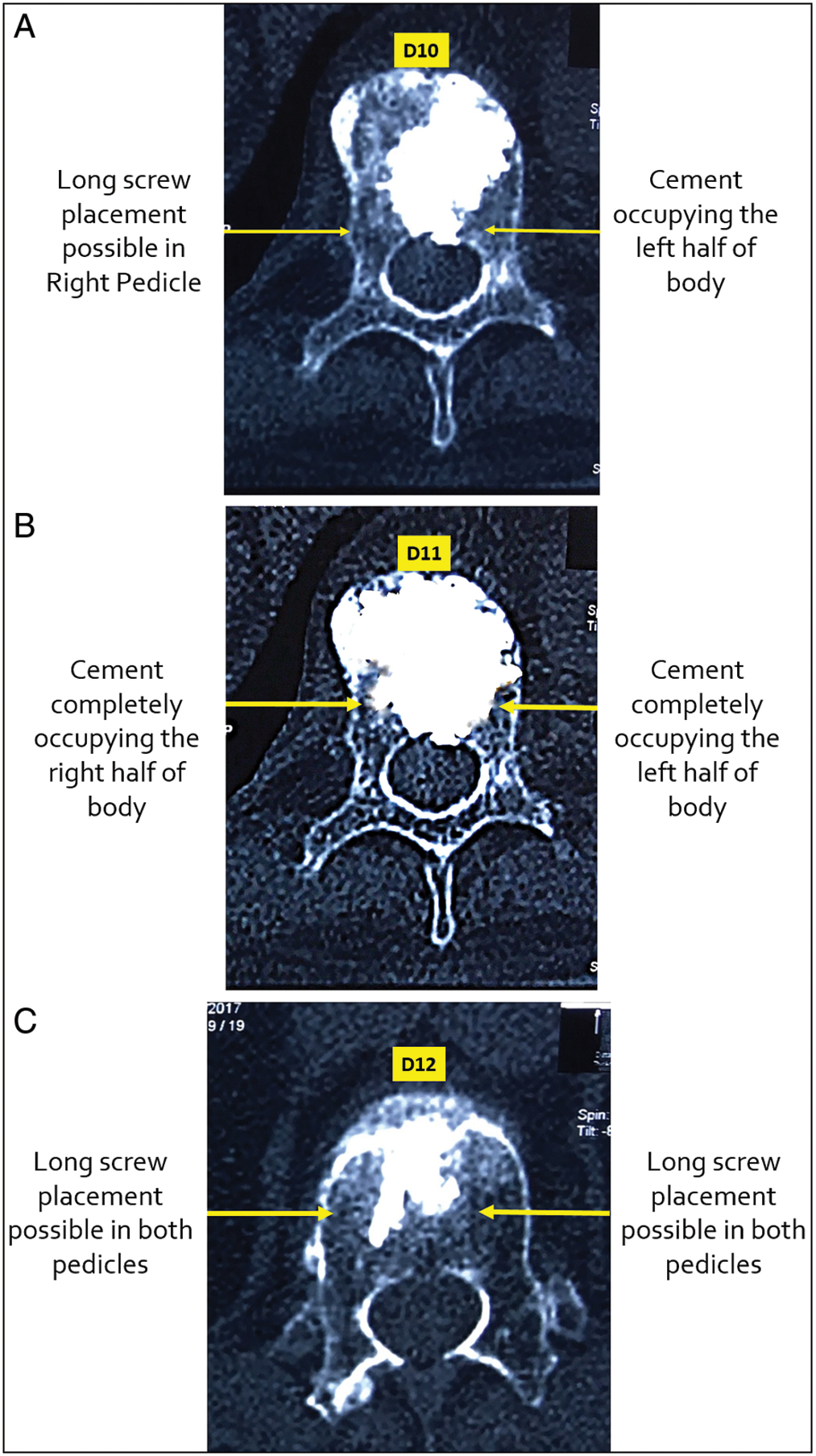 (A) Axial cut of D10 showing relatively empty right half. (B) Axial cut of D11 showing the cement completely occupying the body. (C) Axial cut of D12 showing minimal cement filling in the body