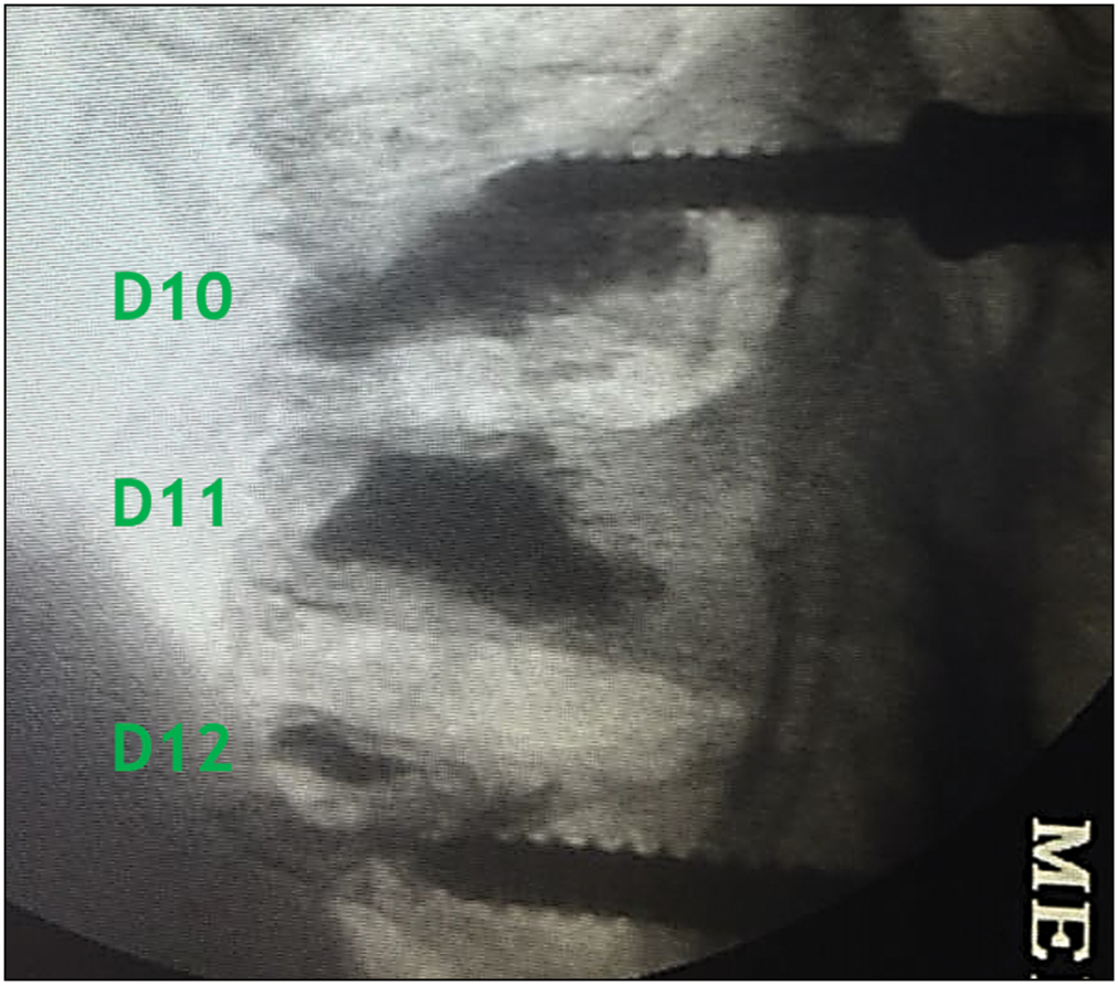 Intraoperative image showing the D10 screw passed superior to the cement mantle