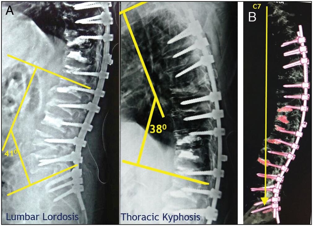 (A) Restoration of normal thoracic kyphosis and lumbar lordosis. (B) Restoration of normal sagittal balance