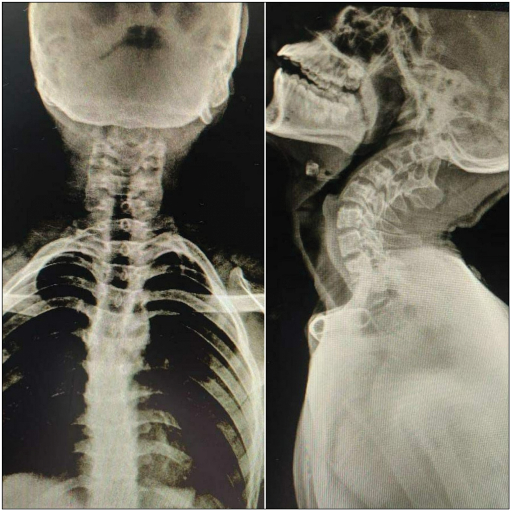 Preoperative cervical spine X-rays showing occipitalized atlas and C2-C3 vertebral fusion