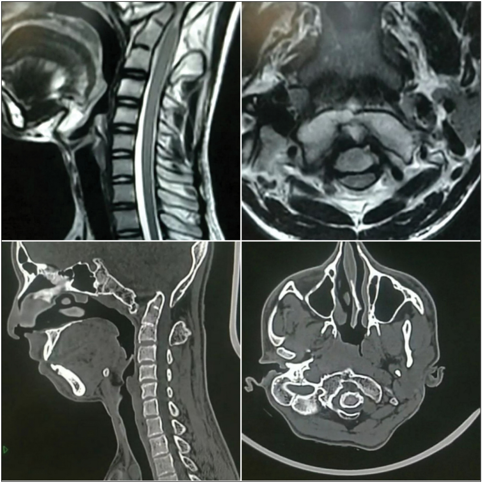 Preoperative MRI and CT scan cuts of cervical spine with ADI more than 9.8 mm