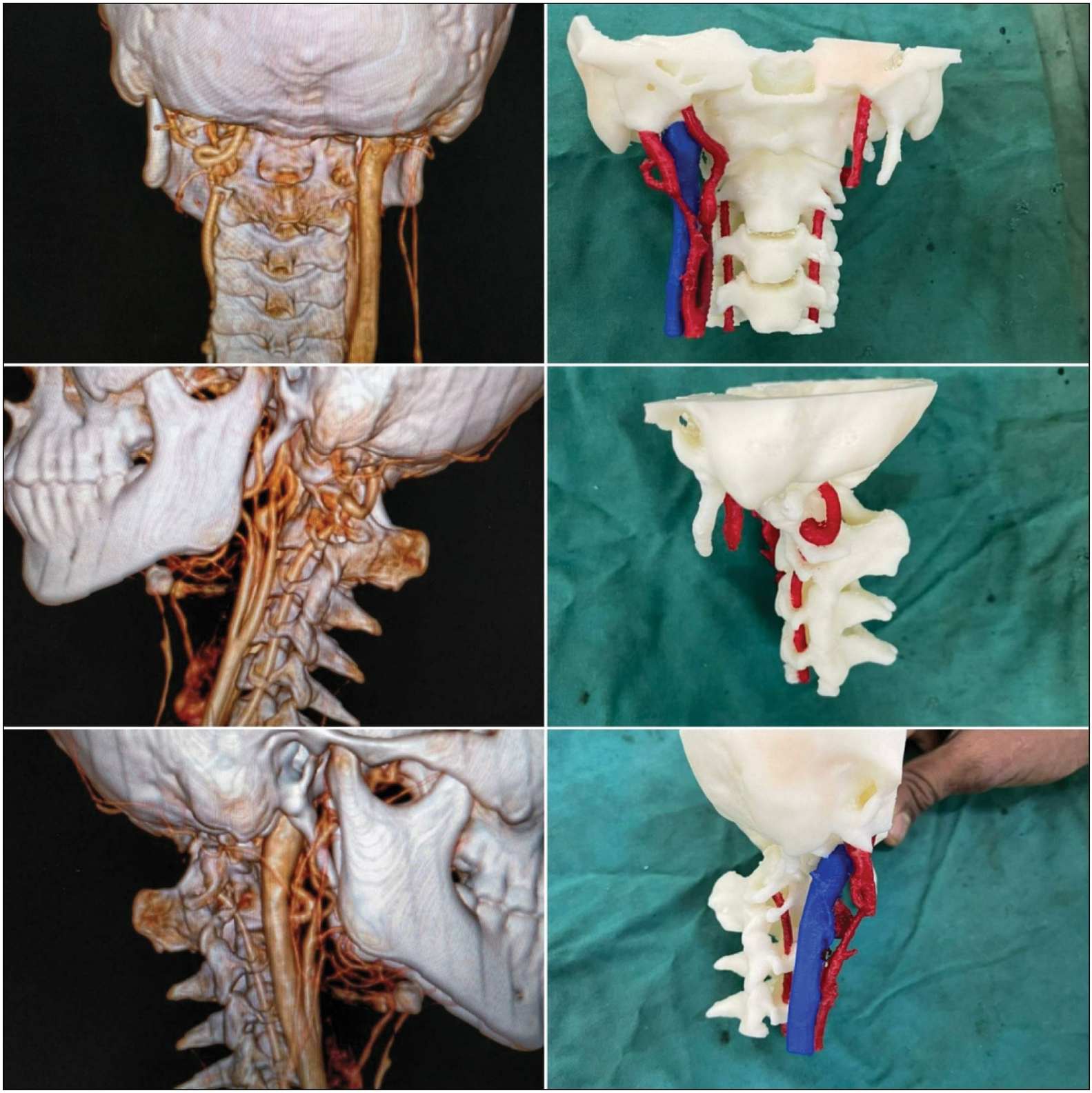 Showing 3D CT angiography and 3D reconstruction model of cervical spine preoperatively