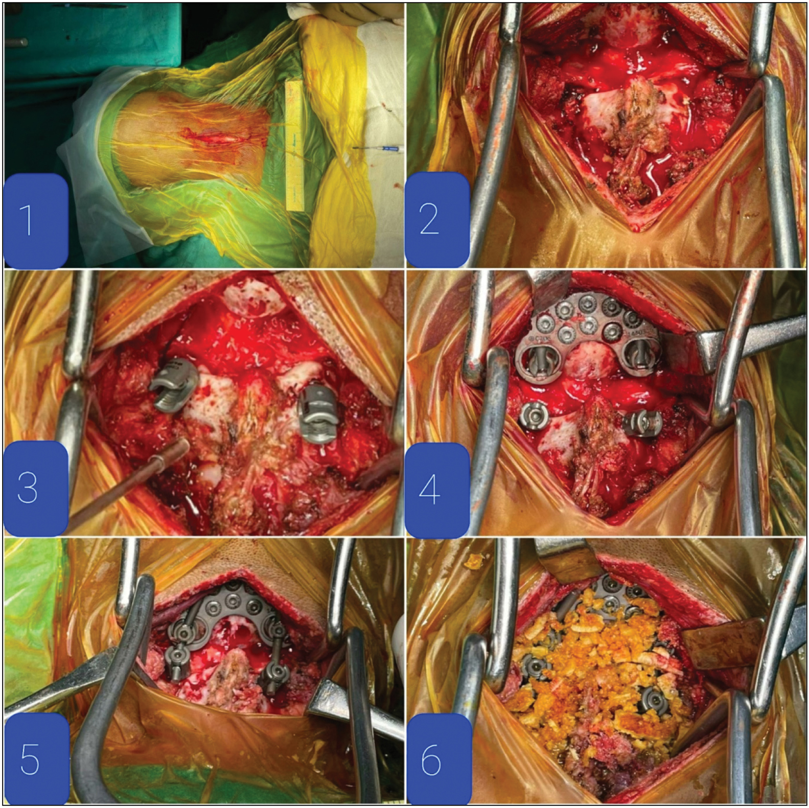 Intraoperative pictures showing 1. Midline incision, 2. Exposure of lamina and pedicles of C2 vertebra and occiput below superior nuchal line, 3. C2 pedicle screws inserted, 4. Occipital plate fixed below superior nuchal line, 5. Connecting rods attached on both sides, and 6. Onlay bone allografting done after placing in antibiotic solution