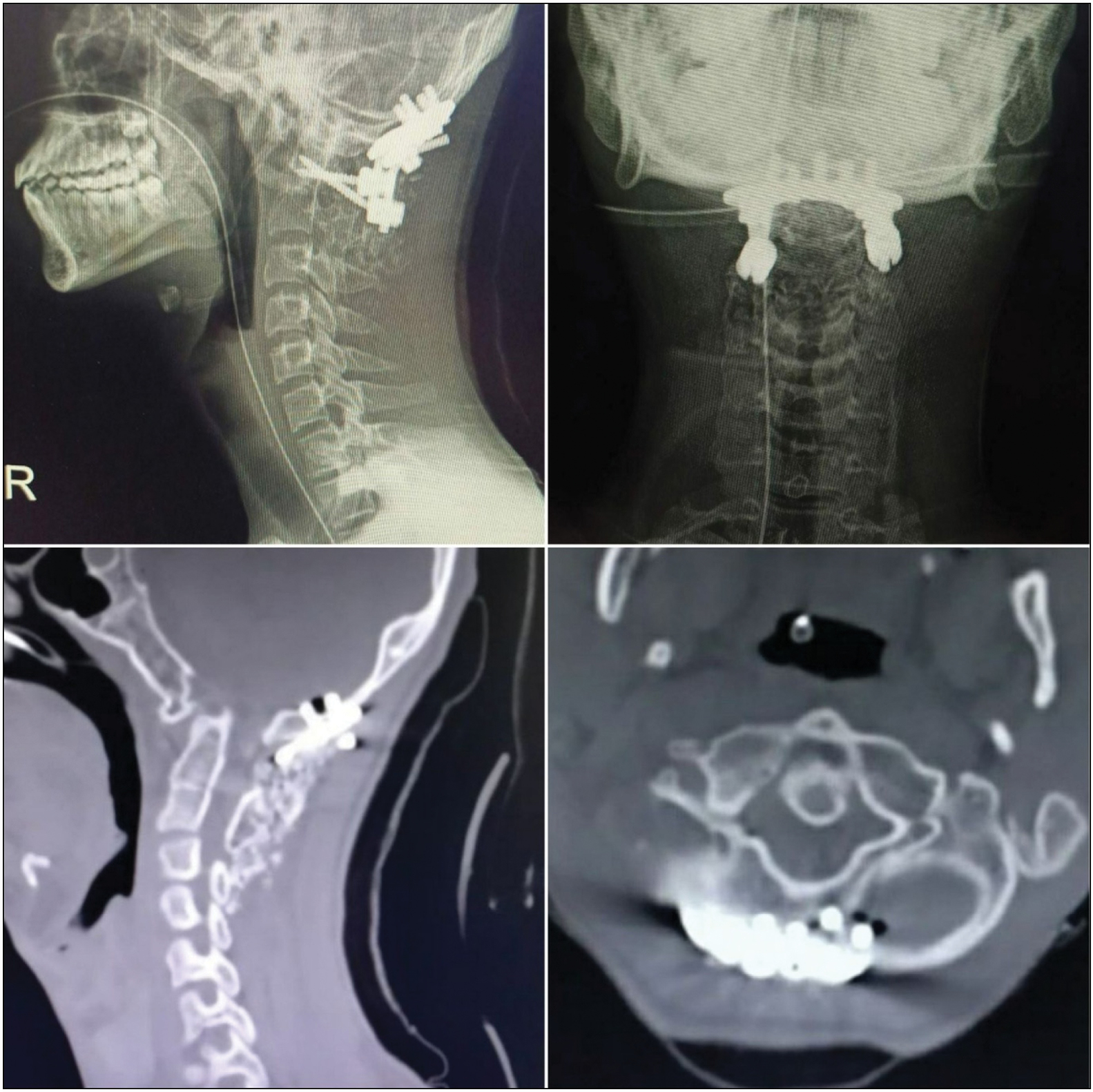 Immediate postoperative X-rays and CT scan showing decreased ADI