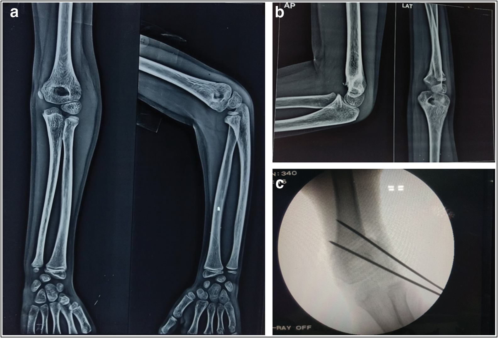 (A) Index trauma radiograph suggestive of supracondylar fracture of humerus. (B) Radiograph showing mal united supracondylar fracture humerus 9 months post index trauma. (C) Intraoperative C-ARM image