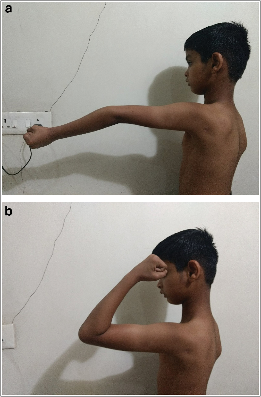 (A and B) Hyperextension of elbow with limited flexion