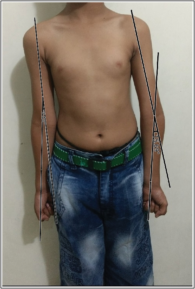 Preoperative carrying angle: right side 7.50° and left side –15.69°