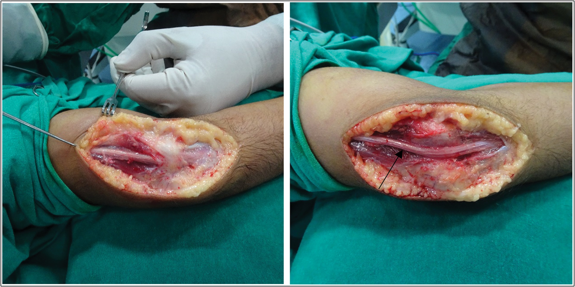 Marked arrow showing atrophied ulnar nerve below medial condyle, which was subsequently transposed anteriorly