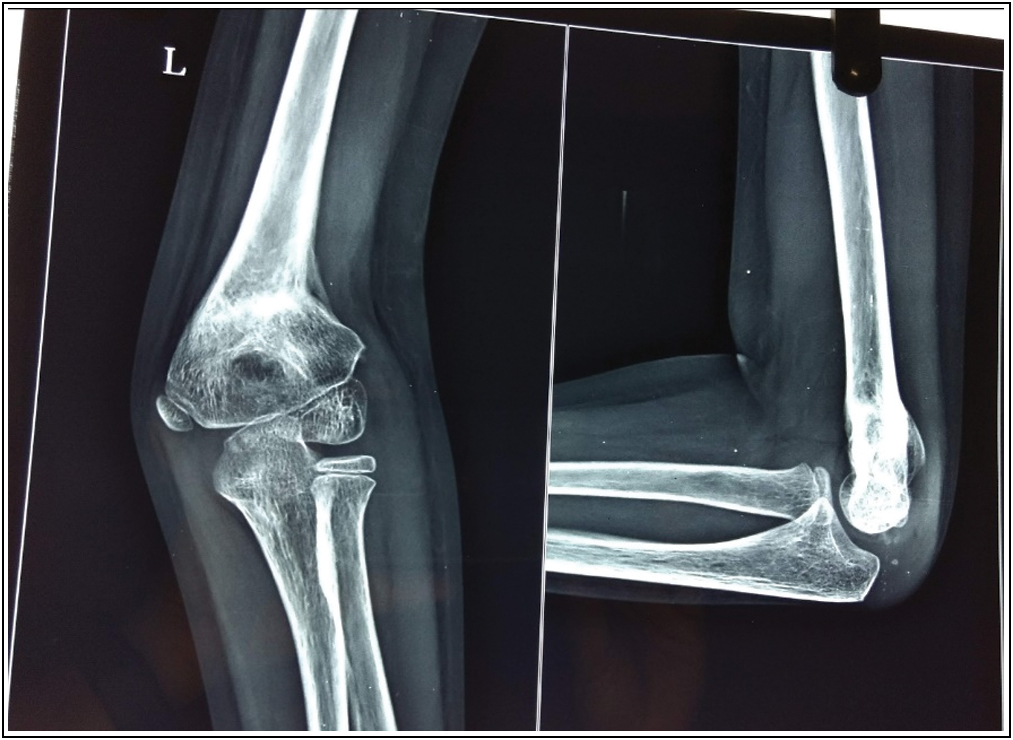 Three-month postoperative radiograph showing completely united osteotomy