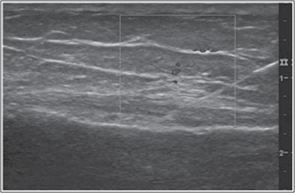 Ultrasound image showing the needle in the inflamed pes anserine bursa