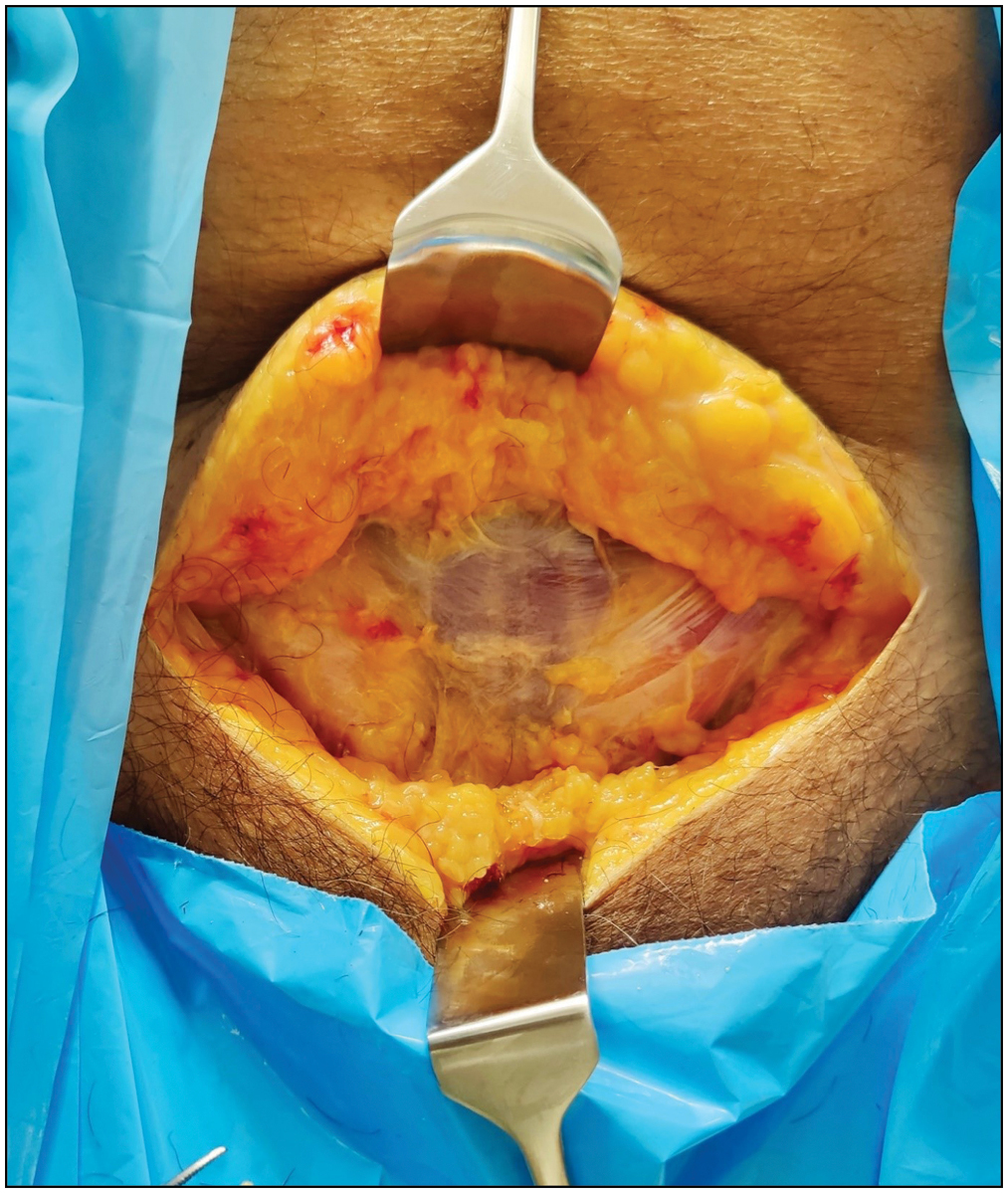 Subcutaneous tissue divided in line with the skin incision to expose the rectus fascia