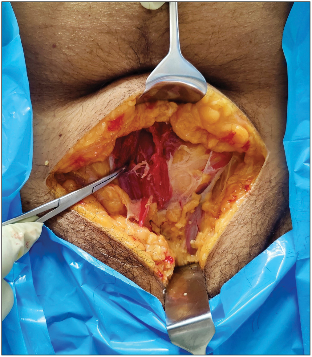 Rectus fascia incised longitudinally along the linea alba to expose the rectus muscles