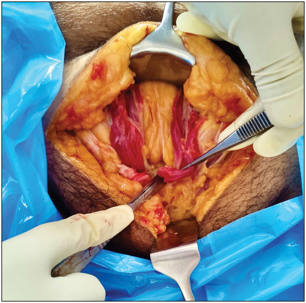 Medial part of the rectus muscle partly detached from the upper part of the symphysis on the side of dissection to allow the rectus to retract for a better exposure