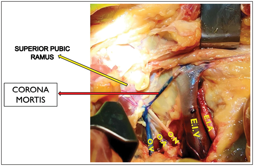 Presence of corona mortis vessel (venous variant) connecting the external iliac vein and obturator vein