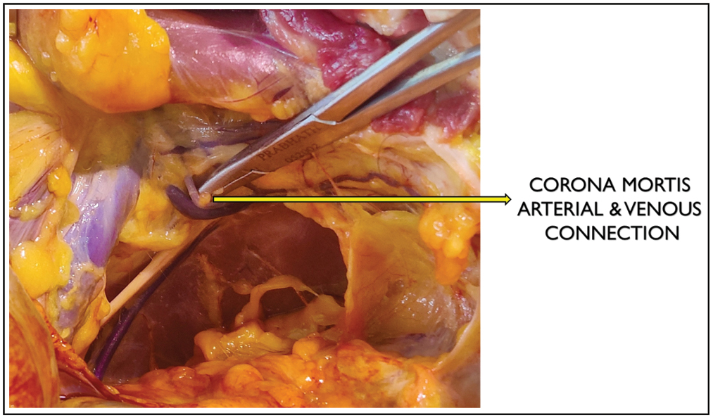 Corona mortis with both arterial and venous variants