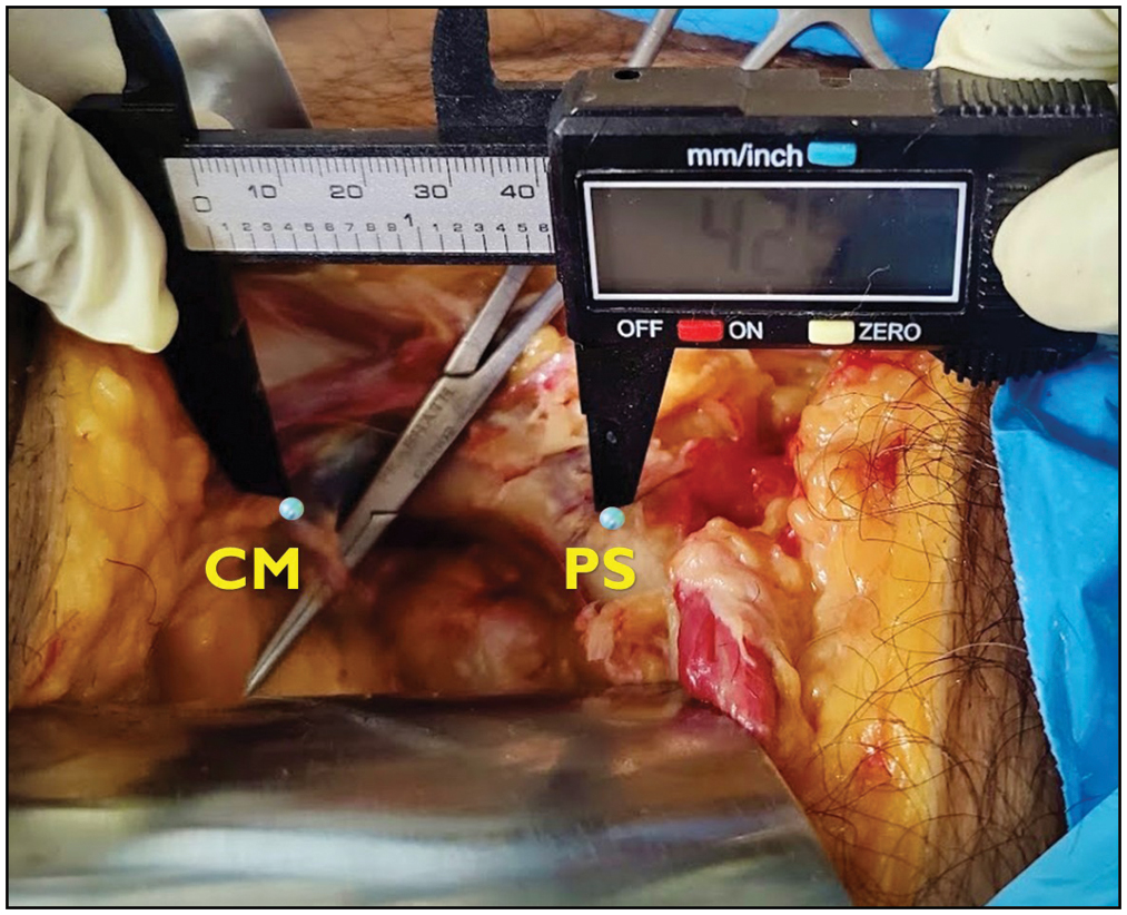 Distance between the corona mortis and pubic symphysis is measured using a digital vernier caliper with marker pins placed over the symphysis pubis and the site of corona mortis