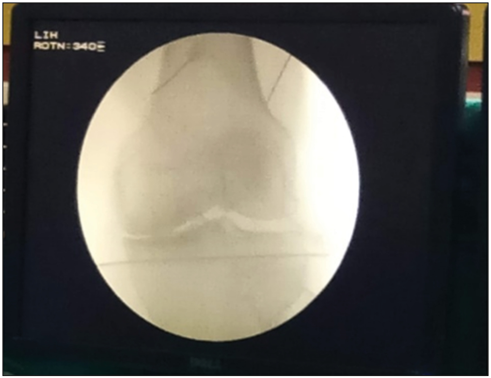 Fluoroscopic image in AP view showing RF cannula placement at the junction of shaft of femur with the femoral condyles where the superomedial and superolateral genicular nerves traverse