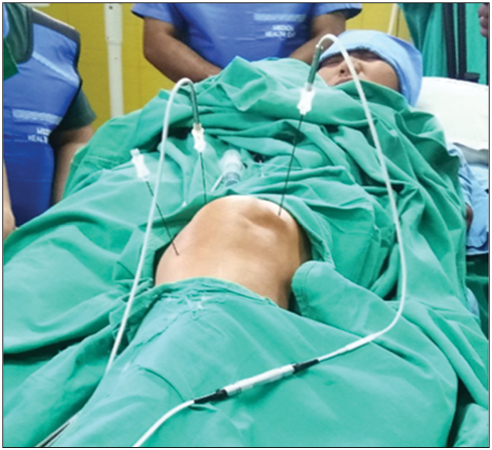 Placement of 22G RF cannula at superolateral, superomedial, and inferomedial genicular nerves followed by insertion of RF probes to confirm needle position at the target nerves by sensory stimulation (50 Hz at 0.3–0.5 V) and to avoid motor nerve ablation (stimulation with 2 Hz at 1 V). Continuous RF ablation of the three genicular nerves is then done at 70°C for 90 min, as shown in [Figure 3]