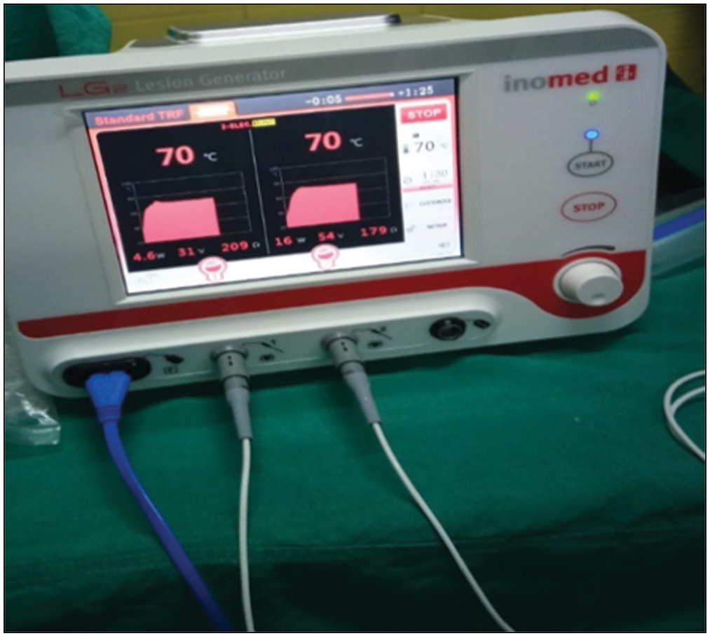 Image shows RFA of two Genicular nerves being performed simultaneously using unipolar two electrodes