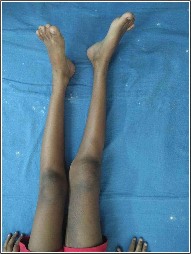 Clinical Photograph of Right limb