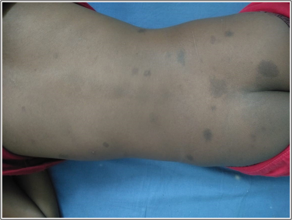 Photograph of Skin lesion