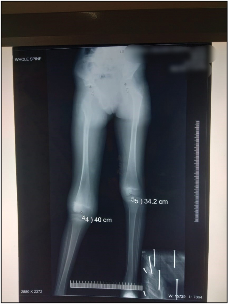 X ray of patients Showing Lengthen of Femur