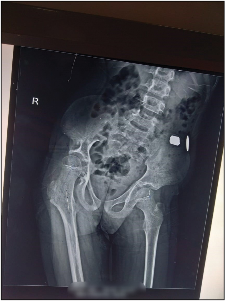 X-Ray pelvis with both hip